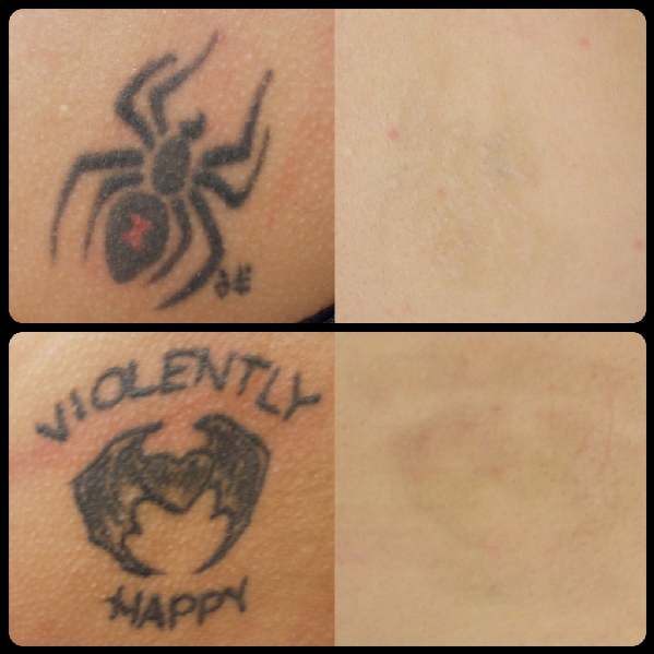 Laser Tattoo Removal Washington DC