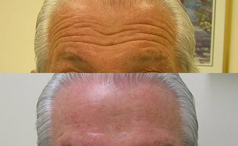 Photos | Botox Before and After Treatment