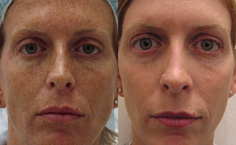 IPL Photofacial: Is it Right for You?