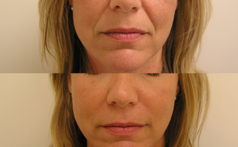 Juvederm in Washington DC and Olney