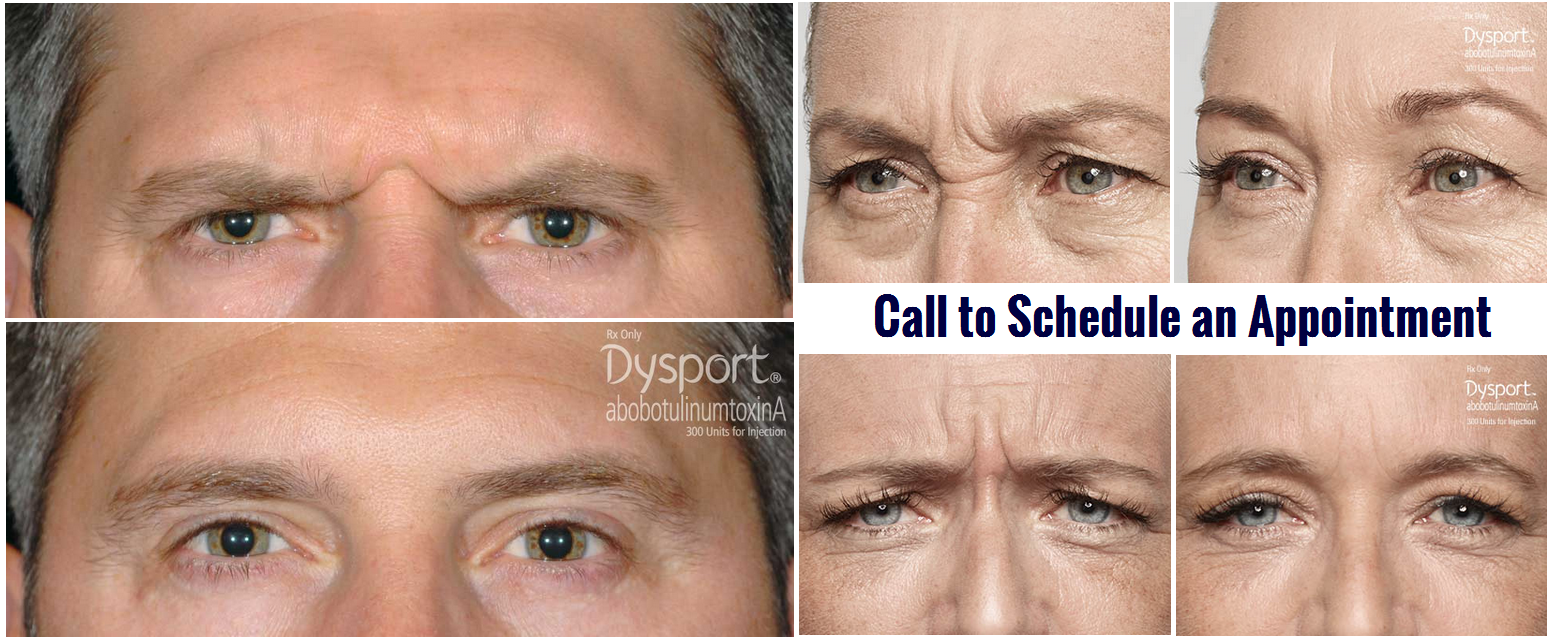 all-about-dysport-injectable-treatment-before-after-photos