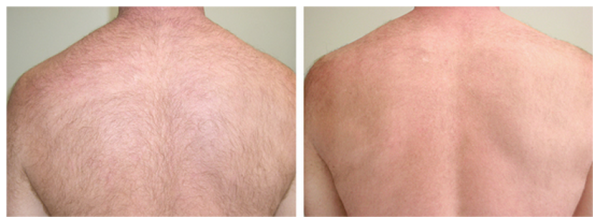 Laser Hair Removal Washington DC - Cosmetic Skin Institute | Skin Care in  Washington DC, Olney, & Maryland