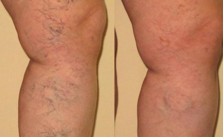 Sclerotherapy in Washington DC and Olney