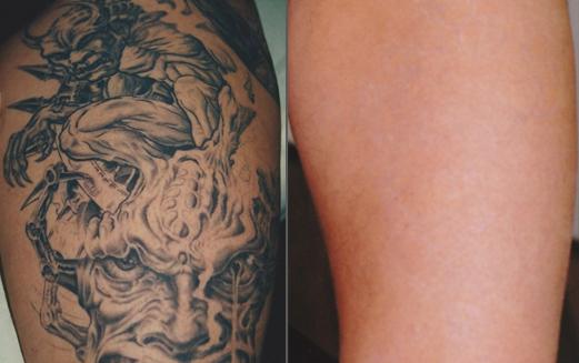 Laser Tattoo Removal Before After Photos Atlanta Georgia | Roswell |  Marietta