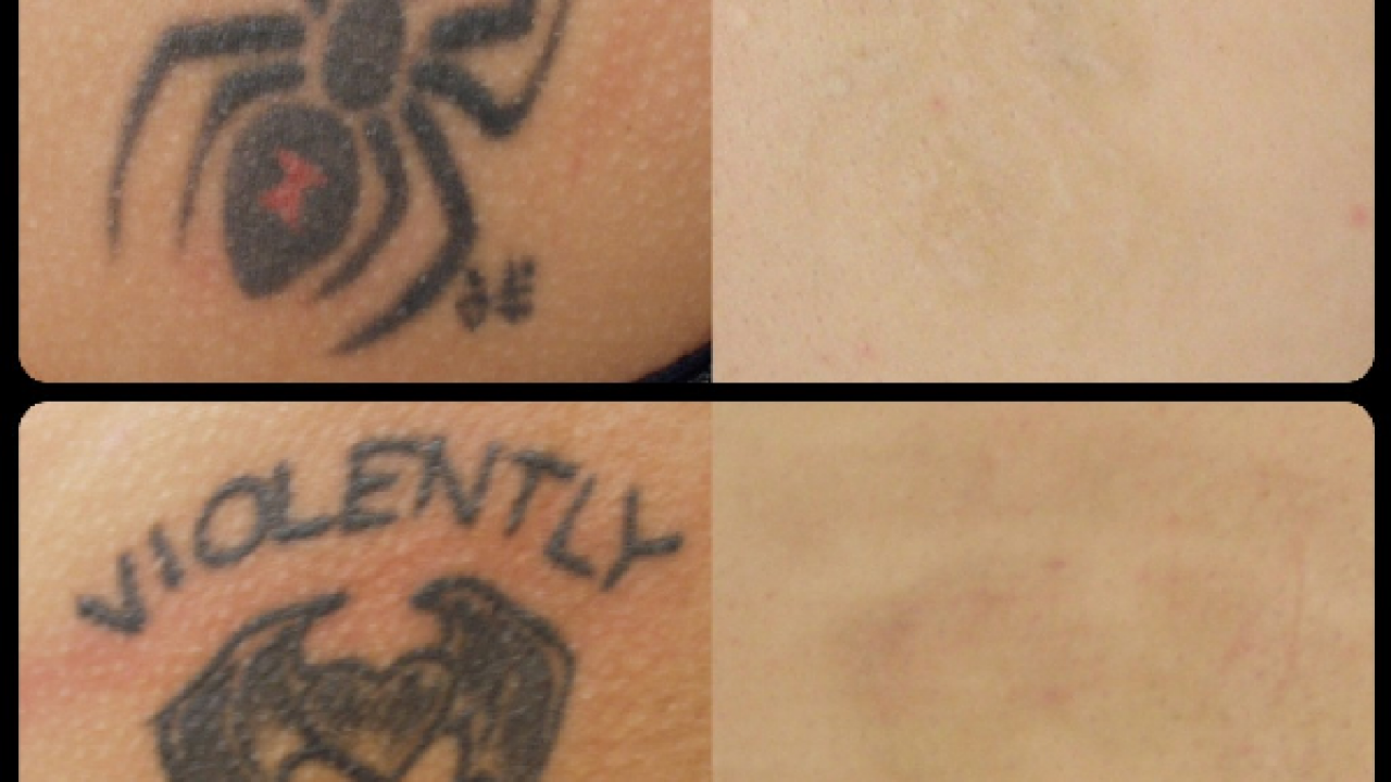 Laser Tattoo Removal Washington DC - Cosmetic Skin Institute | Skin Care in  Washington DC, Olney, & Maryland