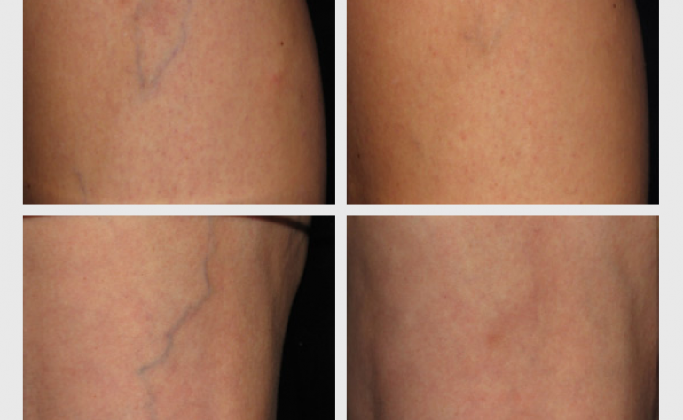 COSMETIC SKIN INSTITUTE MONTHLY BLOG | JANUARY 2014: SCLEROTHERAPY