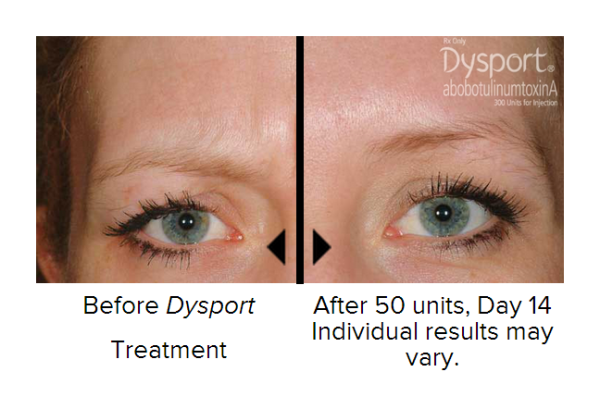 dysport-before-and-after-3-cosmetic-skin-institute-skin-care-in