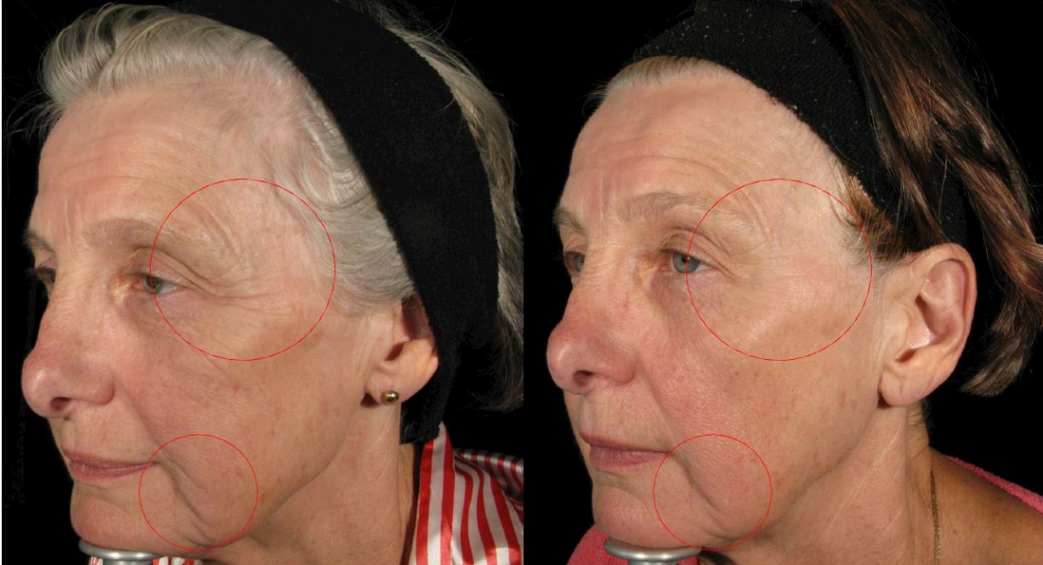 Environ Revival 5 Months Before and After - Cosmetic Skin Institute