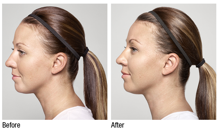 Restylane-Silk-Before-and-After-1.jpg