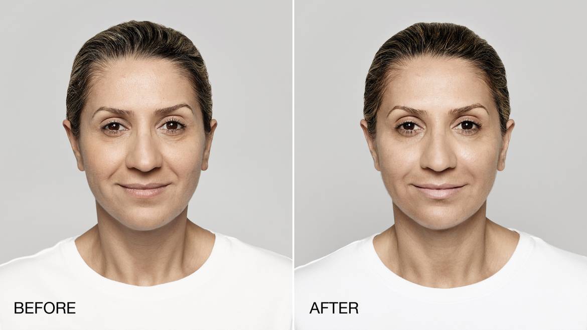 Restylane-Lyft-Before-and-After-1.jpg