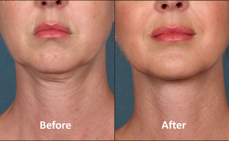 Kybella in Washington DC and Olney