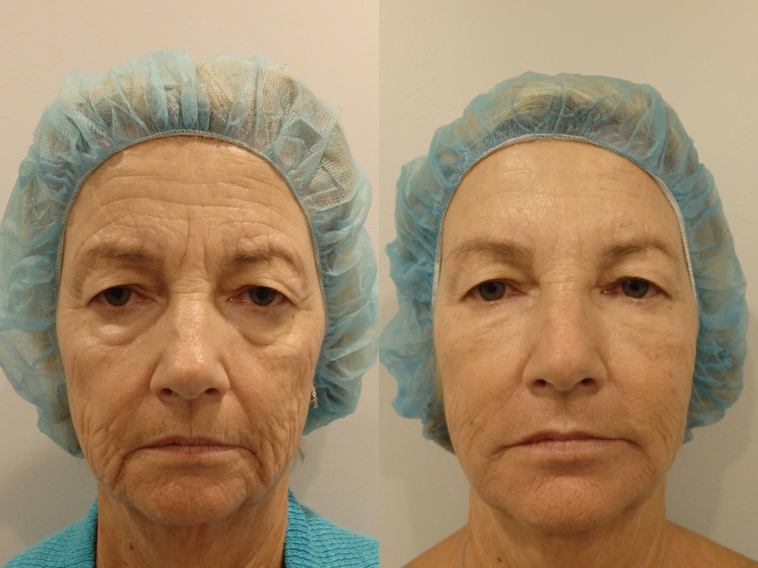 Before And After Image Gallery - Cosmetic Skin Institute | Skin Care In ...