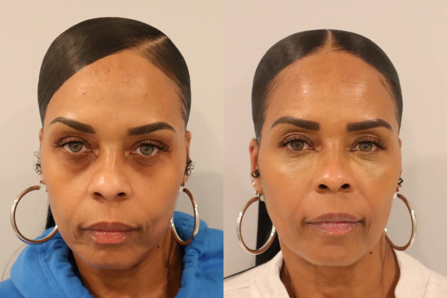 Before And After Image Gallery Cosmetic Skin Institute Skin Care In Washington Dc Olney 7987