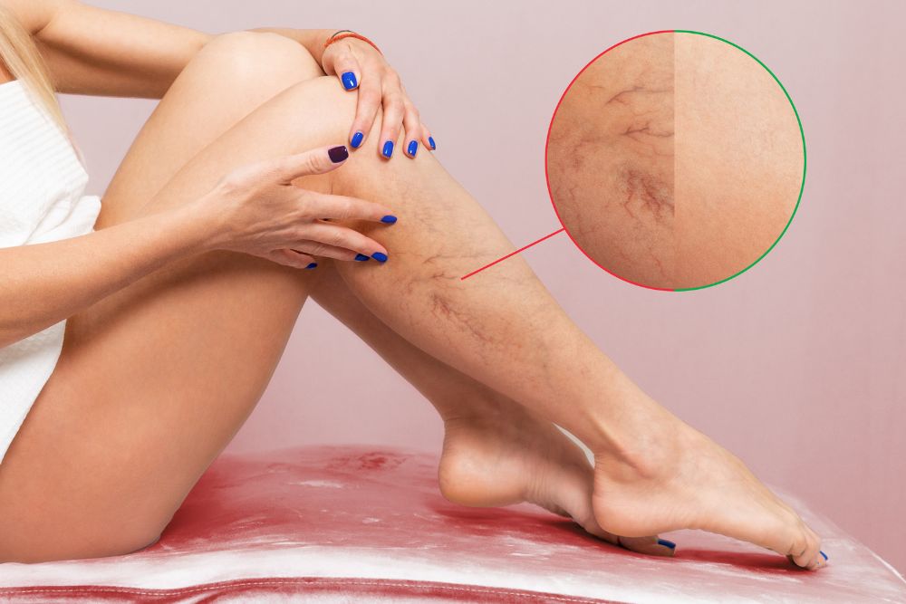 Vein Treatments