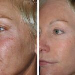 The Benefits of Erbium & Fraxel Laser Resurfacing