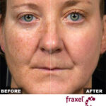 The Benefits of Fraxel (Fractional Laser Resurfacing)